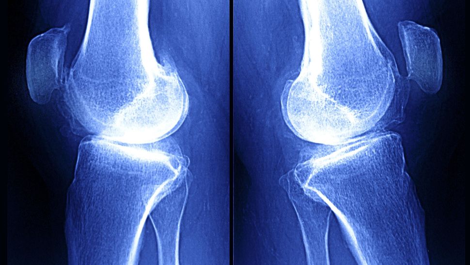Osteoartrite, test del sangue AI batte i raggi X e la prevede 10 anni prima Futuro Prossimo
