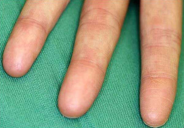 Adermatoglifia, nascere senza impronte digitali: che dice la scienza Futuro Prossimo