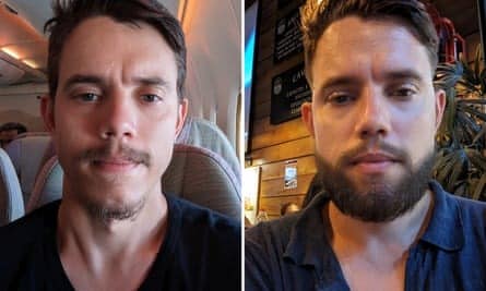 Uomini in crisi: ora spopola anche il trapianto di barba Futuro Prossimo