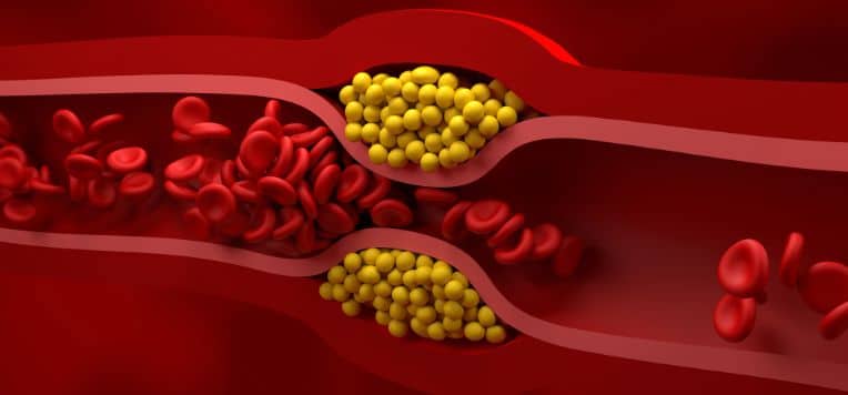 Infarto addio: le nanoparticelle “mangiano” il grasso nelle arterie Futuro Prossimo